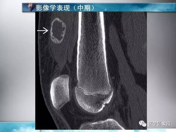 【PPT】骨化性肌炎的影像学诊断