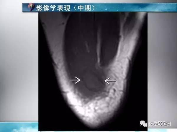 【PPT】骨化性肌炎的影像学诊断