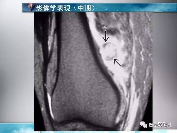 【PPT】骨化性肌炎的影像学诊断