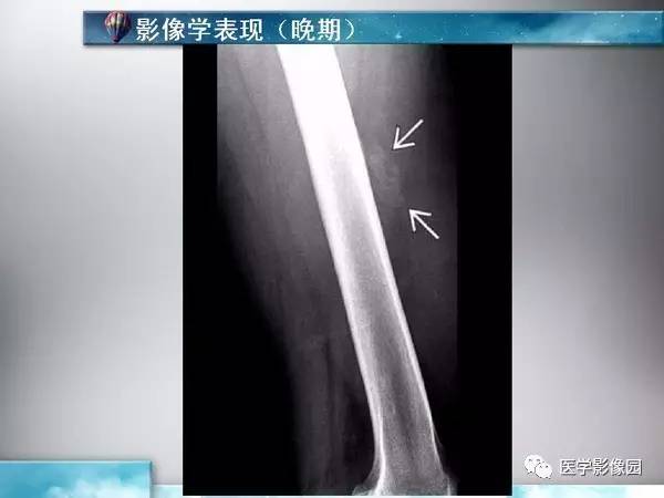 【PPT】骨化性肌炎的影像学诊断