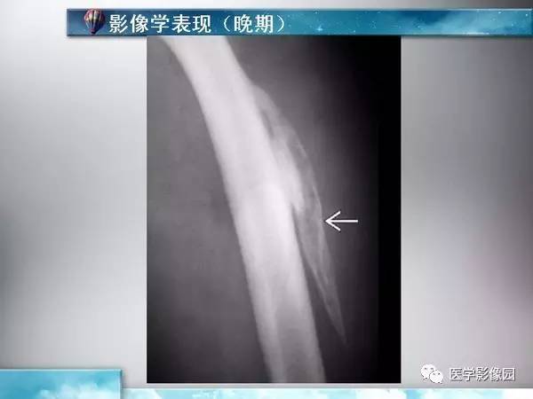 【PPT】骨化性肌炎的影像学诊断