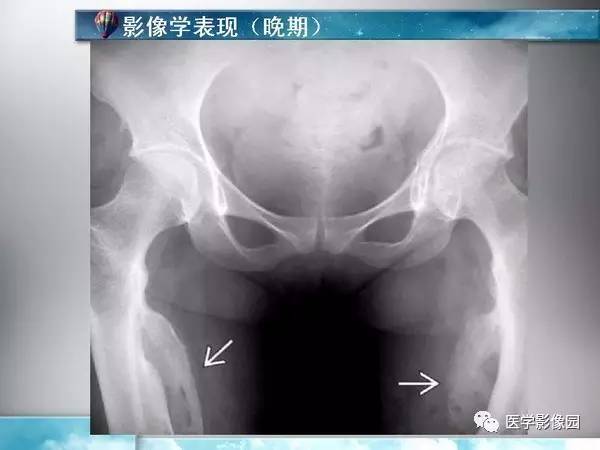 【PPT】骨化性肌炎的影像学诊断