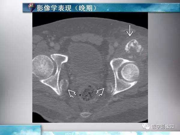 【PPT】骨化性肌炎的影像学诊断