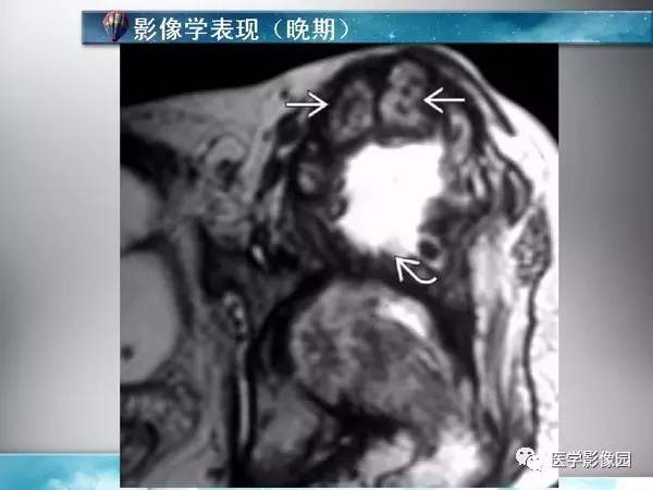 【PPT】骨化性肌炎的影像学诊断