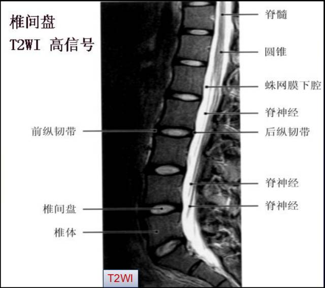 腰椎间盘MRI基本知识 腰椎间盘MRI基本知识
