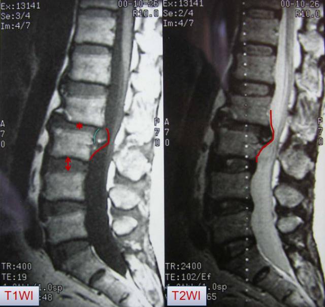 腰椎间盘MRI基本知识 腰椎间盘MRI基本知识