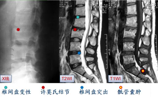 腰椎间盘MRI基本知识 腰椎间盘MRI基本知识