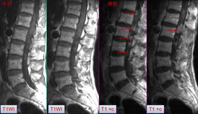 腰椎间盘MRI基本知识 腰椎间盘MRI基本知识
