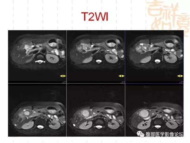 【病例】胆囊炎合并肝脓肿VS胆囊癌合并邻近肝脏直接侵犯鉴别要点 【病例】胆囊炎合并肝脓肿VS胆囊癌合并邻近肝脏直接侵犯鉴别要点