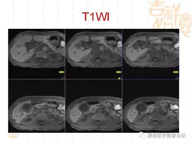 【病例】胆囊炎合并肝脓肿VS胆囊癌合并邻近肝脏直接侵犯鉴别要点 【病例】胆囊炎合并肝脓肿VS胆囊癌合并邻近肝脏直接侵犯鉴别要点