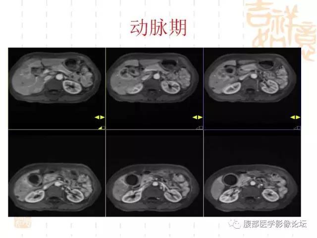 【病例】胆囊炎合并肝脓肿VS胆囊癌合并邻近肝脏直接侵犯鉴别要点 【病例】胆囊炎合并肝脓肿VS胆囊癌合并邻近肝脏直接侵犯鉴别要点