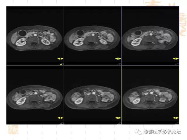 【病例】胆囊炎合并肝脓肿VS胆囊癌合并邻近肝脏直接侵犯鉴别要点 【病例】胆囊炎合并肝脓肿VS胆囊癌合并邻近肝脏直接侵犯鉴别要点