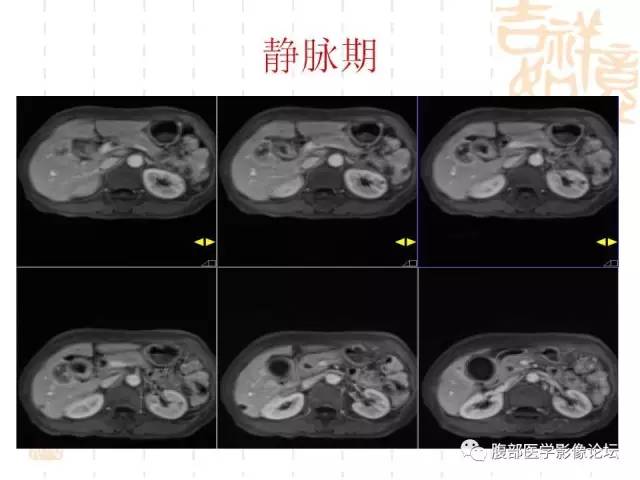 【病例】胆囊炎合并肝脓肿VS胆囊癌合并邻近肝脏直接侵犯鉴别要点 【病例】胆囊炎合并肝脓肿VS胆囊癌合并邻近肝脏直接侵犯鉴别要点