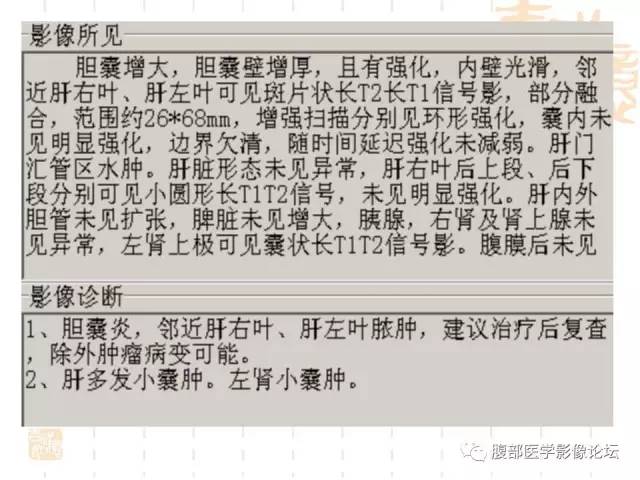 【病例】胆囊炎合并肝脓肿VS胆囊癌合并邻近肝脏直接侵犯鉴别要点 【病例】胆囊炎合并肝脓肿VS胆囊癌合并邻近肝脏直接侵犯鉴别要点