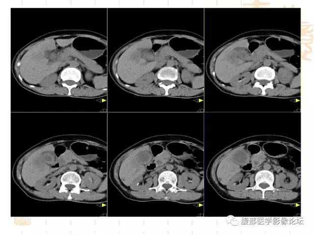 【病例】胆囊炎合并肝脓肿VS胆囊癌合并邻近肝脏直接侵犯鉴别要点 【病例】胆囊炎合并肝脓肿VS胆囊癌合并邻近肝脏直接侵犯鉴别要点