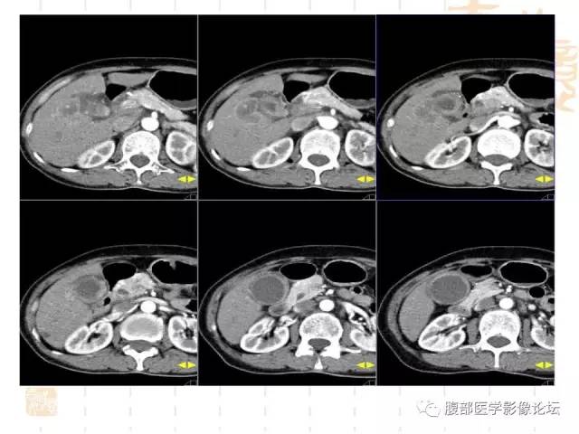 【病例】胆囊炎合并肝脓肿VS胆囊癌合并邻近肝脏直接侵犯鉴别要点 【病例】胆囊炎合并肝脓肿VS胆囊癌合并邻近肝脏直接侵犯鉴别要点