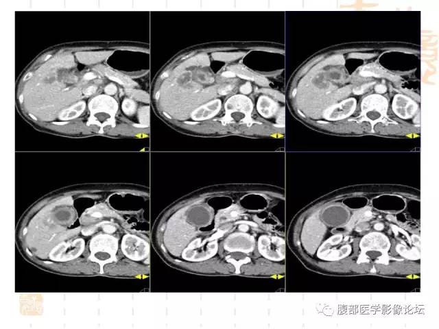 【病例】胆囊炎合并肝脓肿VS胆囊癌合并邻近肝脏直接侵犯鉴别要点 【病例】胆囊炎合并肝脓肿VS胆囊癌合并邻近肝脏直接侵犯鉴别要点