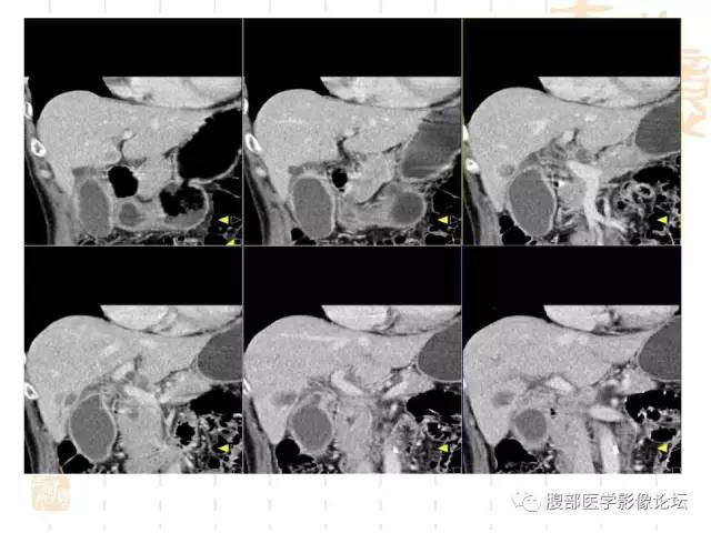 【病例】胆囊炎合并肝脓肿VS胆囊癌合并邻近肝脏直接侵犯鉴别要点 【病例】胆囊炎合并肝脓肿VS胆囊癌合并邻近肝脏直接侵犯鉴别要点