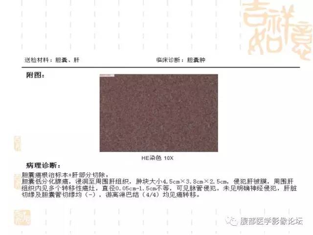 【病例】胆囊炎合并肝脓肿VS胆囊癌合并邻近肝脏直接侵犯鉴别要点 【病例】胆囊炎合并肝脓肿VS胆囊癌合并邻近肝脏直接侵犯鉴别要点