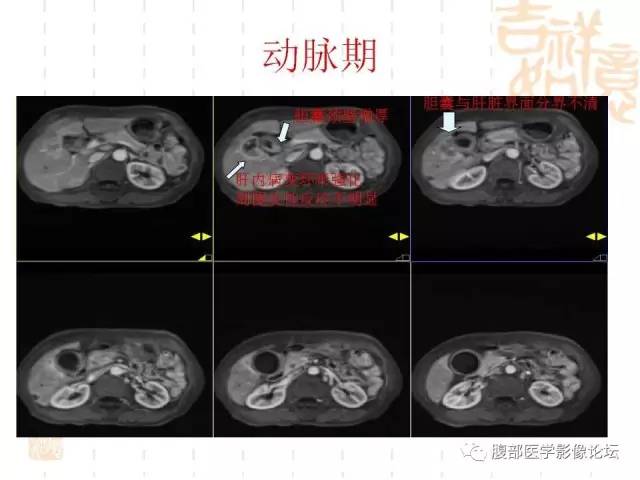 【病例】胆囊炎合并肝脓肿VS胆囊癌合并邻近肝脏直接侵犯鉴别要点 【病例】胆囊炎合并肝脓肿VS胆囊癌合并邻近肝脏直接侵犯鉴别要点