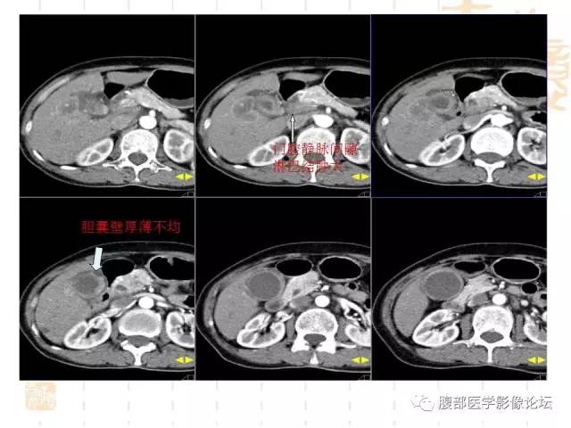 【病例】胆囊炎合并肝脓肿VS胆囊癌合并邻近肝脏直接侵犯鉴别要点 【病例】胆囊炎合并肝脓肿VS胆囊癌合并邻近肝脏直接侵犯鉴别要点