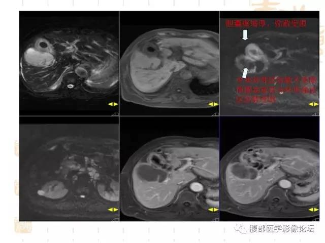 【病例】胆囊炎合并肝脓肿VS胆囊癌合并邻近肝脏直接侵犯鉴别要点 【病例】胆囊炎合并肝脓肿VS胆囊癌合并邻近肝脏直接侵犯鉴别要点