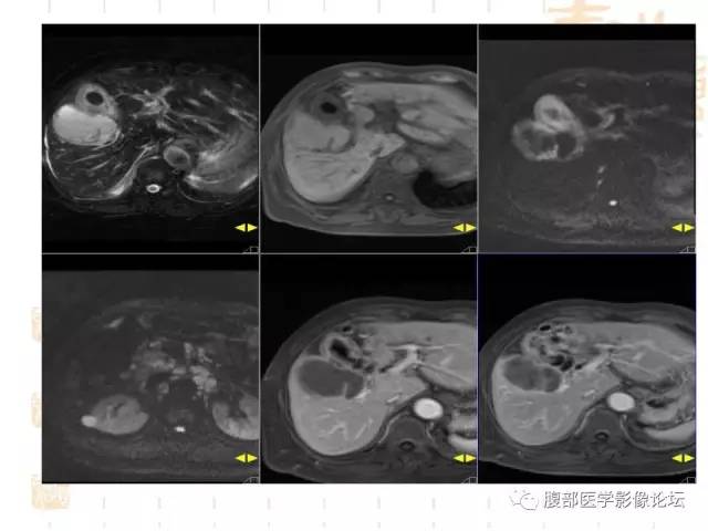【病例】胆囊炎合并肝脓肿VS胆囊癌合并邻近肝脏直接侵犯鉴别要点 【病例】胆囊炎合并肝脓肿VS胆囊癌合并邻近肝脏直接侵犯鉴别要点