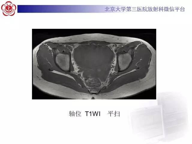 【病例】纤维-卵泡膜细胞瘤1例MR影像表现