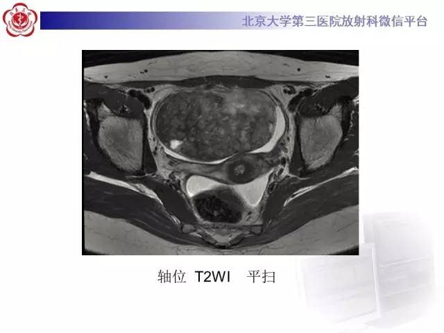 【病例】纤维-卵泡膜细胞瘤1例MR影像表现
