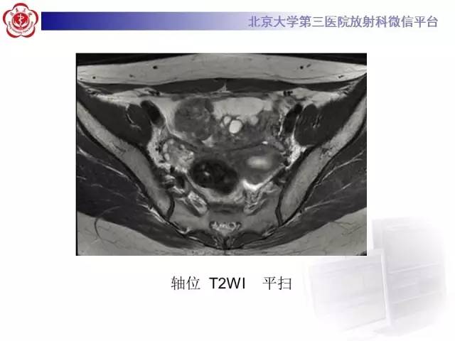 【病例】纤维-卵泡膜细胞瘤1例MR影像表现