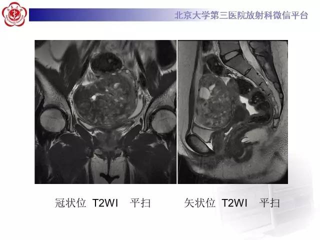 【病例】纤维-卵泡膜细胞瘤1例MR影像表现