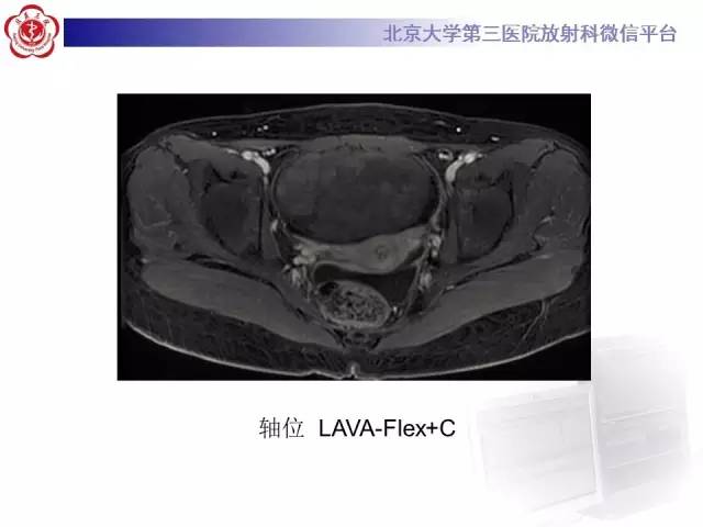 【病例】纤维-卵泡膜细胞瘤1例MR影像表现