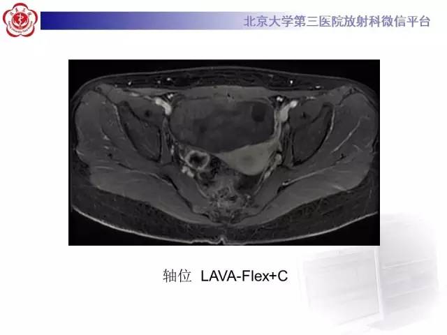【病例】纤维-卵泡膜细胞瘤1例MR影像表现