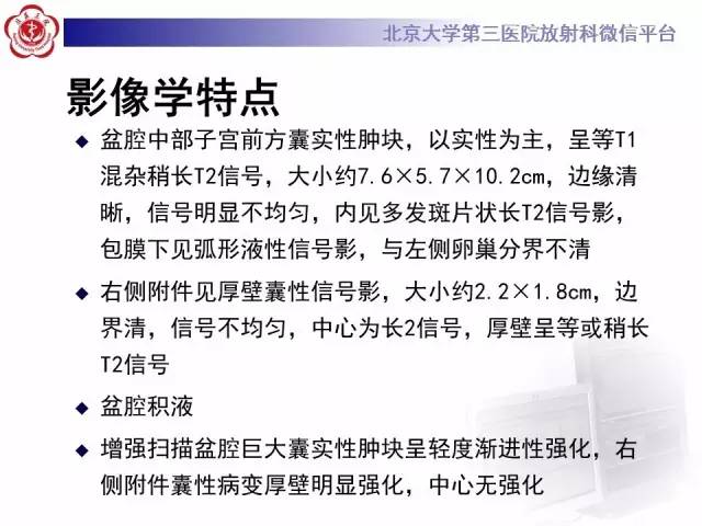 【病例】纤维-卵泡膜细胞瘤1例MR影像表现