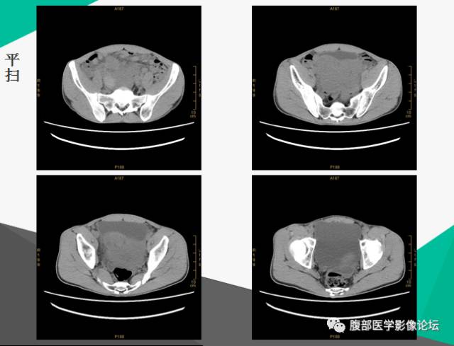【病例】胃肠道外间质瘤1例CT及MR影像表现 【病例】胃肠道外间质瘤1例CT及MR影像表现