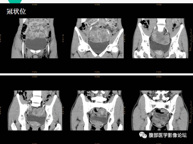 【病例】胃肠道外间质瘤1例CT及MR影像表现 【病例】胃肠道外间质瘤1例CT及MR影像表现