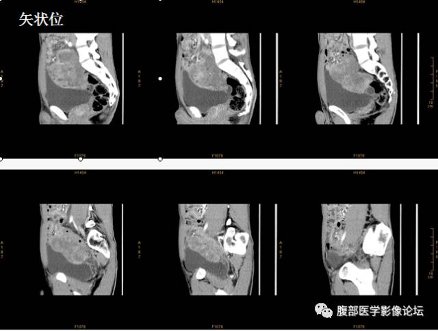 【病例】胃肠道外间质瘤1例CT及MR影像表现 【病例】胃肠道外间质瘤1例CT及MR影像表现