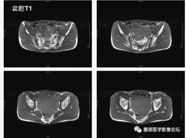 【病例】胃肠道外间质瘤1例CT及MR影像表现 【病例】胃肠道外间质瘤1例CT及MR影像表现