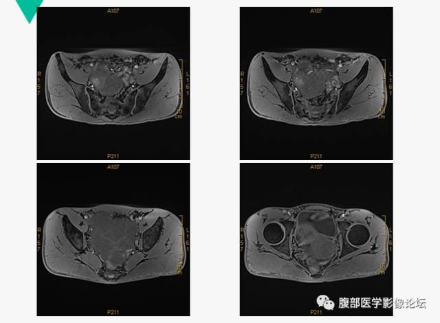 【病例】胃肠道外间质瘤1例CT及MR影像表现 【病例】胃肠道外间质瘤1例CT及MR影像表现