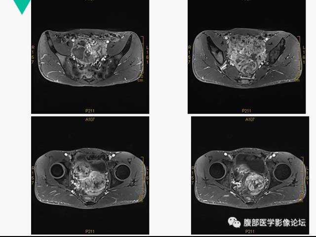 【病例】胃肠道外间质瘤1例CT及MR影像表现 【病例】胃肠道外间质瘤1例CT及MR影像表现