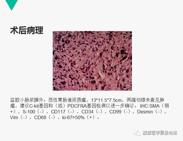 【病例】胃肠道外间质瘤1例CT及MR影像表现 【病例】胃肠道外间质瘤1例CT及MR影像表现