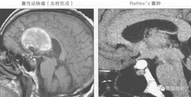 【书摘】鞍上T1WI高信号肿瘤的鉴别诊断