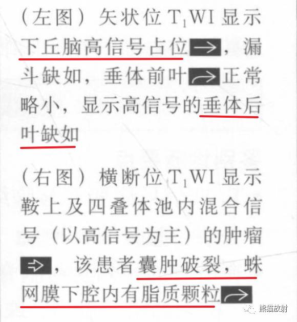 【书摘】鞍上T1WI高信号肿瘤的鉴别诊断