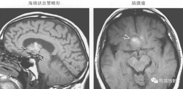 【书摘】鞍上T1WI高信号肿瘤的鉴别诊断
