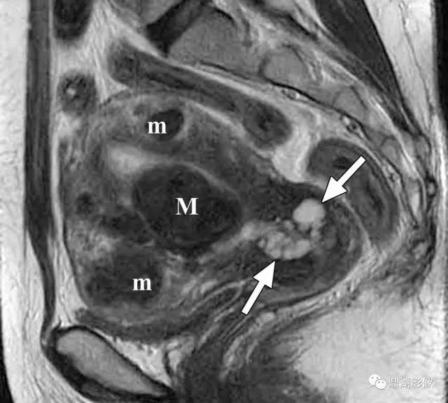 纳氏囊肿（nabothian cyst）