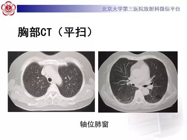【病例】过敏性肺炎1例CT影像表现