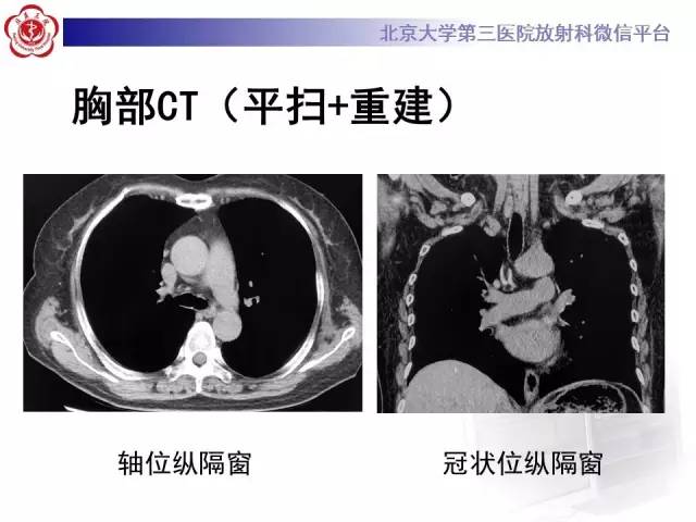 【病例】过敏性肺炎1例CT影像表现