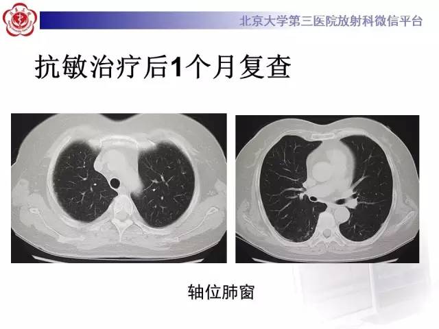 【病例】过敏性肺炎1例CT影像表现