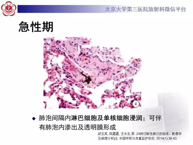 【病例】过敏性肺炎1例CT影像表现