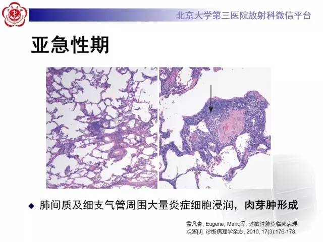【病例】过敏性肺炎1例CT影像表现